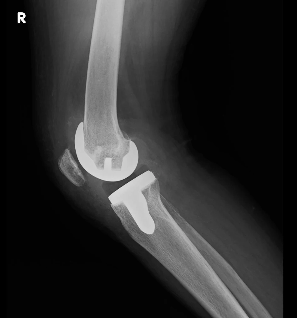 Radiografía lateral de prótesis de rodilla